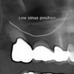 before sinus lift x-ray view female patient case 1