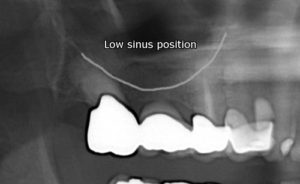 before sinus lift x-ray view female patient case 1