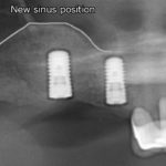 after sinus lift x-ray view female patient case 1