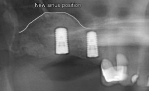 after sinus lift x-ray view female patient case 1