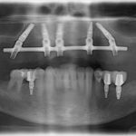 after all on 4 x-ray view female patient case 1