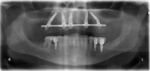 after all on 4 x-ray view female patient case 1