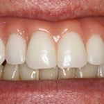 after all on 4 front view female patient case 1
