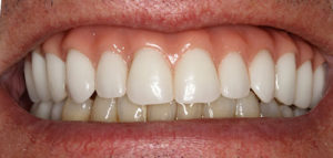 after all on 4 front view female patient case 1