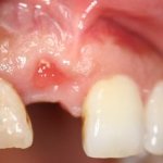 before implant front closeup view female patient case 4