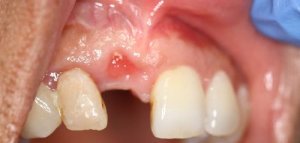 before implant front closeup view female patient case 4