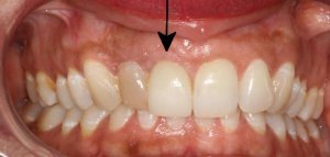 after implant front closeup view female patient case 4