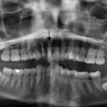 after implant front closeup view female patient case 4