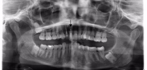 after implant front closeup view female patient case 4