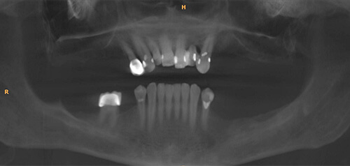 All on 4 Case 1 | Hill Country Oral Surgery